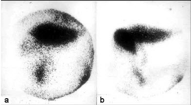 一新生儿患者的99Tcm-EHIDA肝胆动态显像如图，左图为10分钟影像，右图为30分钟影像，诊断是