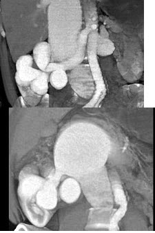 患者有一个可疑的肾团块，结合所示图像，最可能的诊断是()