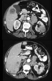 男，54岁，左侧腰痛，伴间歇性血尿2个月余，结合所示图像，下列哪项描述正确()