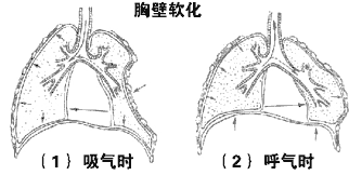 多根多处肋骨骨折（浮动胸壁，连枷胸）的诊断要点、临床表现及相关检查是什么？	