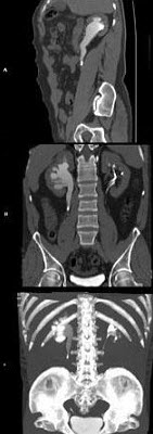 男，36岁，反复发作的右侧腰背部疼痛伴血尿1年余，CT如图所示，下列说法正确的是()