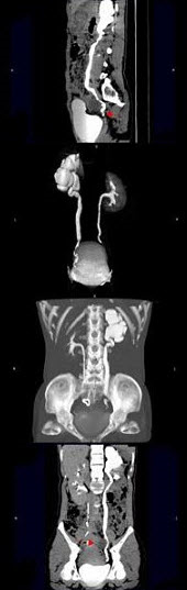 女，42岁，左侧腰背部胀痛不适1年余，5年前行左侧卵巢囊肿切除术，CT检查如图所示，下列说法正确的是