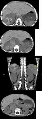 男，5岁，消瘦、贫血、纳差和腹部包块3月余，CT检查如图，下列说法正确的是()