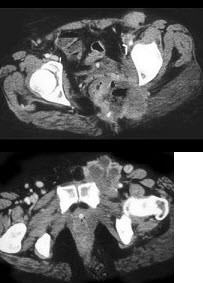 女，57岁，下图是病灶复发时的CT图，结合所示图像，其原发病灶可能是()