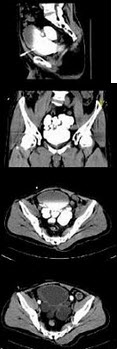 男，62岁，因排尿困难2年，加重伴二段排尿1月，CT扫描如图，下列说法正确的是()