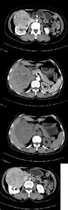 女，57岁，右腰部胀痛6月余，触及右侧腹部包块2月，CT平扫及增强如图所示，下列说法正确的是()