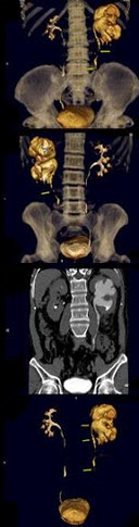 男，58岁，尿频，尿痛伴低热乏力2月，CT如图所示，下列说法正确的是()