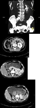 女，35岁，右侧腰部不适，CT增强扫描如图所示，下列说法正确的是()