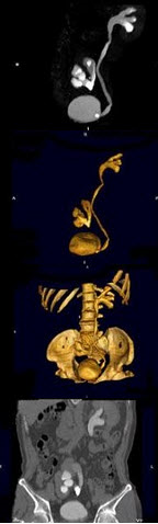 男，65岁，反复发作的下腹部疼痛向会阴部放射伴血尿1年余，CT如图所示，下列说法正确的是()