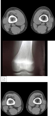 女，15岁，右大腿下段不适，结合所提供的图像，最可能的诊断是()
