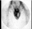 患者，25岁，男，突发左侧阴囊区疼痛，行Tc阴囊显像如图，正确的诊断是()
