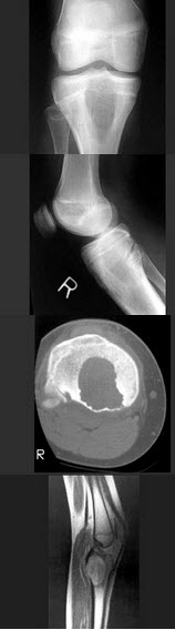 女，13岁，右膝部痛，结合图像，最可能的诊断是()