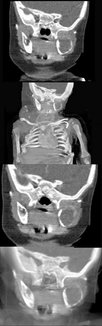 男，2岁，左侧颜面部、右肩部肿块，疼痛，结合图像，最可能的诊断是()
