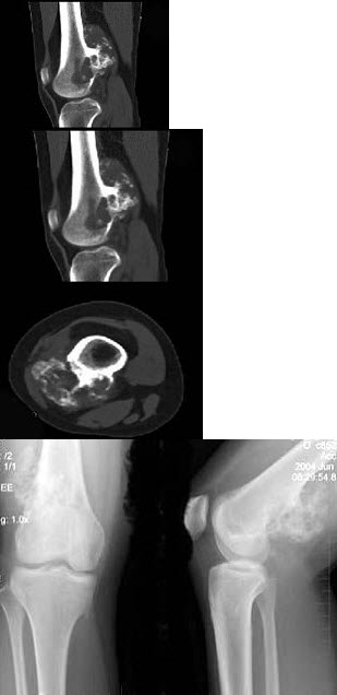 女，20岁，右大腿远端疼痛2年，伴有肿块，结合图像，最可能的诊断是()