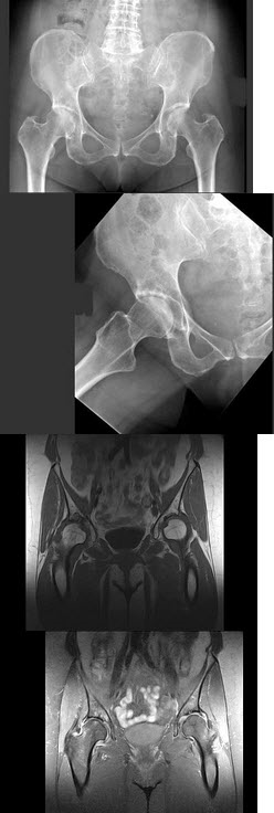 女，67岁，右髋和腹股沟痛6月余，结合图像，最可能的诊断是()
