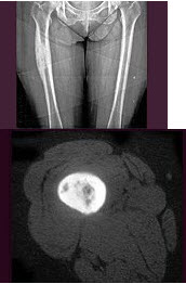 女，28岁，右侧大腿疼痛2月余，夜间加重，服用水杨酸类药物可缓解疼痛，结合影像学检查，最可能的诊断是