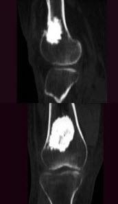 男，27岁，右侧膝盖上部扪及一质硬肿块，结合影像学检查，最可能的诊断是()