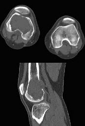 女，38岁，因右大腿远端部有疼痛，可摸到肿块，结合图像，最可能的诊断是()