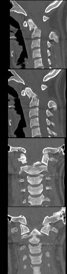 本病例有颈部外伤，主诉颈部疼痛，活动受限，结合所提供CT图像，最可能的诊断是()