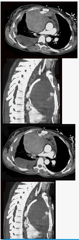 男，33岁，右胸部外伤，胸闷、气短，结合CT图像，最可能的诊断是（）