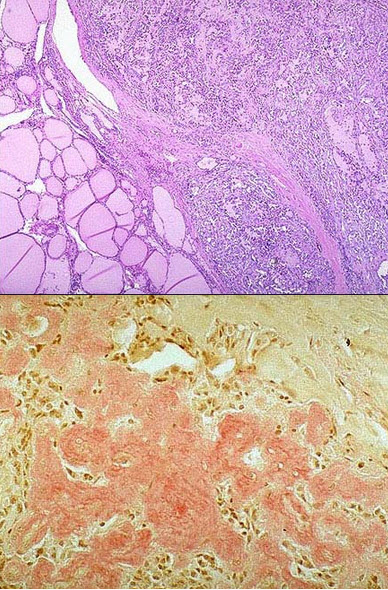 图1为甲状腺髓样癌的镜下观，图2为该肿瘤刚果红染色镜下观，由此二图可知该肿瘤的哪些特征()