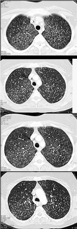 男，36岁，呼吸困难，咳嗽，咳黏稠痰，糖原PAS染色阳性，结合CT图像，最可能的诊断是（）