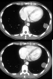 男，43岁，体检X线发现肺部一占位性病变，CT检查如图，最可能的诊断是（） 