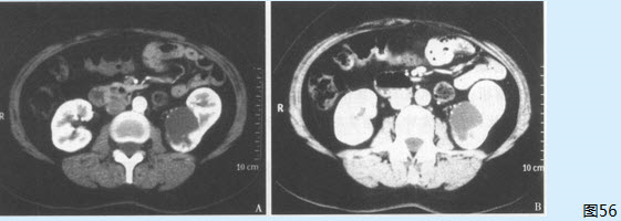 该患者最可能的诊断为（）【提示】该患者的泌尿系统增强CT图像如图56。