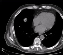 患者男，体检时发现肺内结节，行CT检查如下图。应诊为（） 