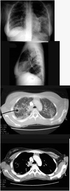 女，18岁，1年前患肺结核经抗结核治疗后好转，现发热、咳嗽、体重下降，结合CT图像，最可能的诊断是（