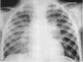 女，3岁，低热、咳嗽2月余，结合胸片，最可能的诊断为（）