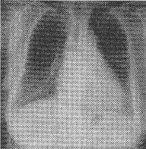 患者女性，46岁。呼吸困难入院。胸部X线平片如下图。右侧肋膈角区垂直于胸壁内侧面的线状影为（）