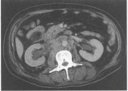目前考虑该患者最可能的诊断是（）【提示】患者泌尿系统CT检查图像见图58，显示主动脉周围可见斑块形成