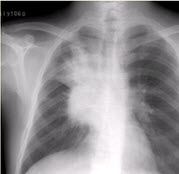 患者男，62岁，痰中带血丝2周，无发热，伴刺激性咳嗽。X线胸片如下图。应诊断为（）