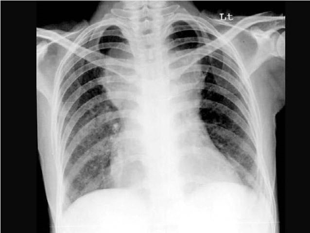 女，45岁，颈强直、发热咳痰2周余，结合CT图像，最可能的诊断是（）