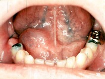 男，16岁，口底左侧囊性肿物逐渐增大1个月余，检查如图。穿刺抽出约5mL粘稠、拉丝样无色透明液体，该