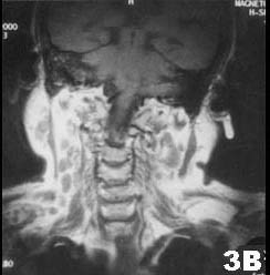 肺结核患者发现双侧腮腺区肿块3个月，缓慢增大，无明显症状。查体腮腺区可触及局限性肿块，边界清，质软，