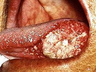 发现左侧舌缘溃疡一月余，迅速增大，进食困难，检查外形见图，颈部淋巴结肿大，最先考虑的疾病应是（）