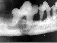 颌面外伤患者，咬合错乱，下唇麻木张口受限，经X线检查如图。应该为（）