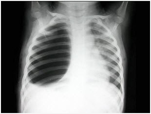 女，9岁，呼吸困难半月余，结合图像，最可能的诊断是（）