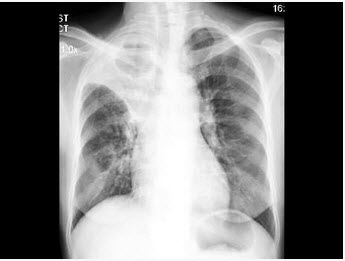 女，48岁，咳嗽2月余，胸片检查如图，最可能的诊断为（）