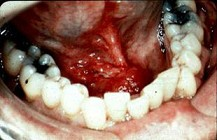 男，40岁，发现右侧口底部有一核桃大小质硬肿块（如图），触诊浸润已过中线。右侧颌下可扪及2个肿大淋巴