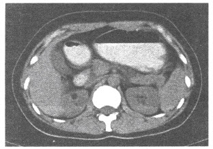 中年女性，无何不适，B超查体偶然发现肾脏占位，行CT检查，如下图，应考虑符合何种疾病（）
