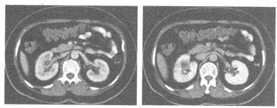 女，33岁。低热、乏力、右腰痛3个月余。CT双期扫描如下图所示，应首先考虑的病变为（）