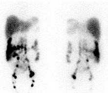 一患者的99Tcm-DX淋巴显像如图，正确的诊断是()