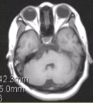 患者女，41岁。右侧面肌抽搐。MRI显示如下图。关于表皮样囊肿与蛛网膜囊肿的鉴别诊断，正确的是（）