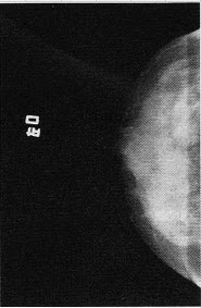 患者女，67岁。发现乳腺包块1个月余，伴乳头溢液，X线图像如下，最有可能的诊断是（）