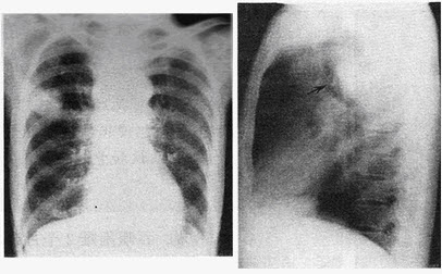 患者男，57岁。反复咳嗽咳痰1个月余，X线图像如下，最有可能的诊断是（）