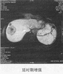 患者男，54岁。体检发现肝脏占位，MR图像如下，最有可能的诊断是（）