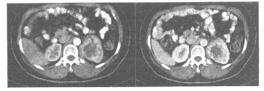 中年男性，CT平扫发现左肾中部实质区等密度占位性病变，增强扫描病灶明显不均匀强化（见下图），考虑哪项